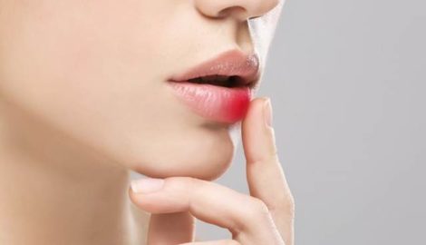 Herpes simplex – ničitel našeho sebevědomí